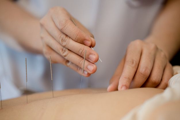 10 Surprising Health Benefits of Acupuncture Therapy You Didn't Know About