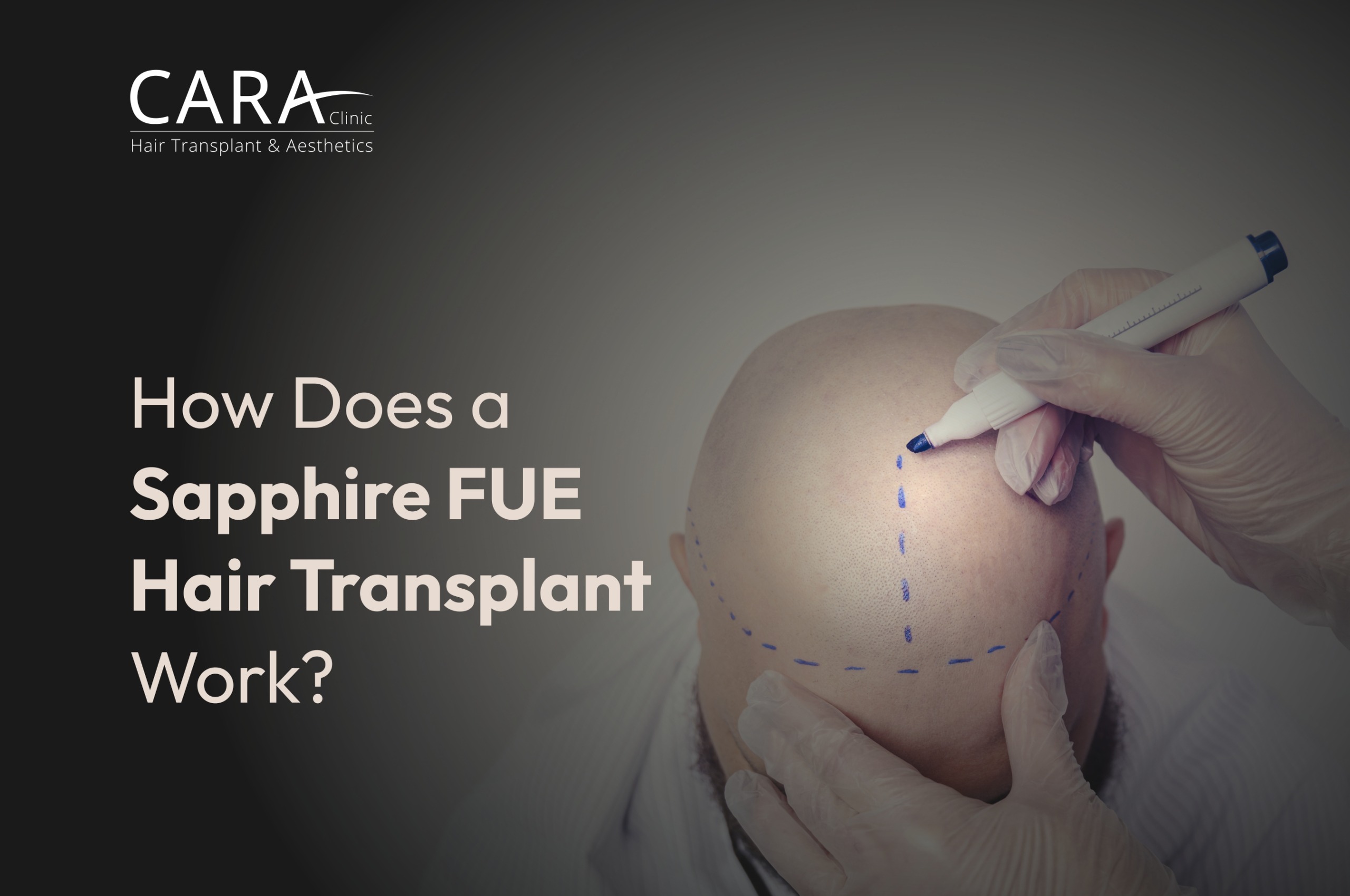 How Does a Sapphire FUE Hair Transplant Work?
