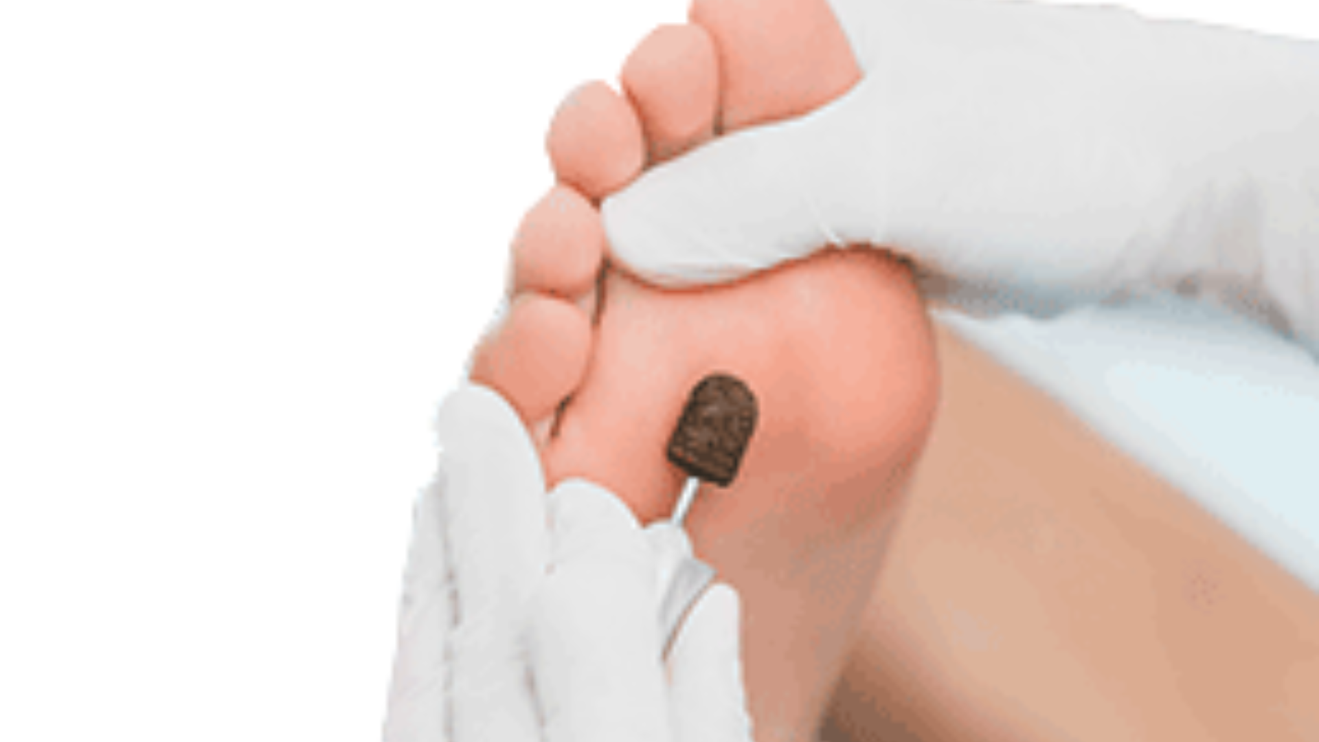 Advanced Diabetic Foot Care Treatments You Should Know
