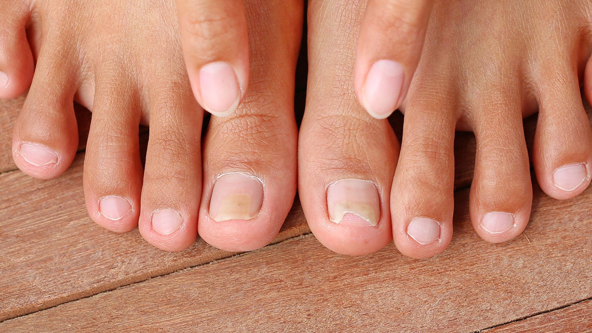 How Much Does Laser Treatment for Toenail Fungus Cost?	