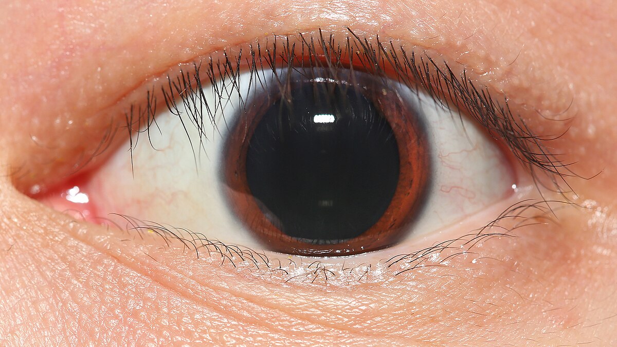 Mydriasis Treatment Market to Soar Due to Diagnostics Advances