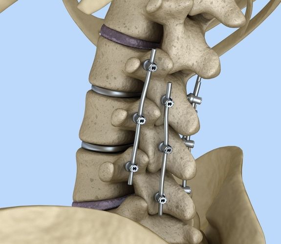 Spinal Osteosynthesis Units Market Set to Grow Owing to Rising Spinal Surgeries