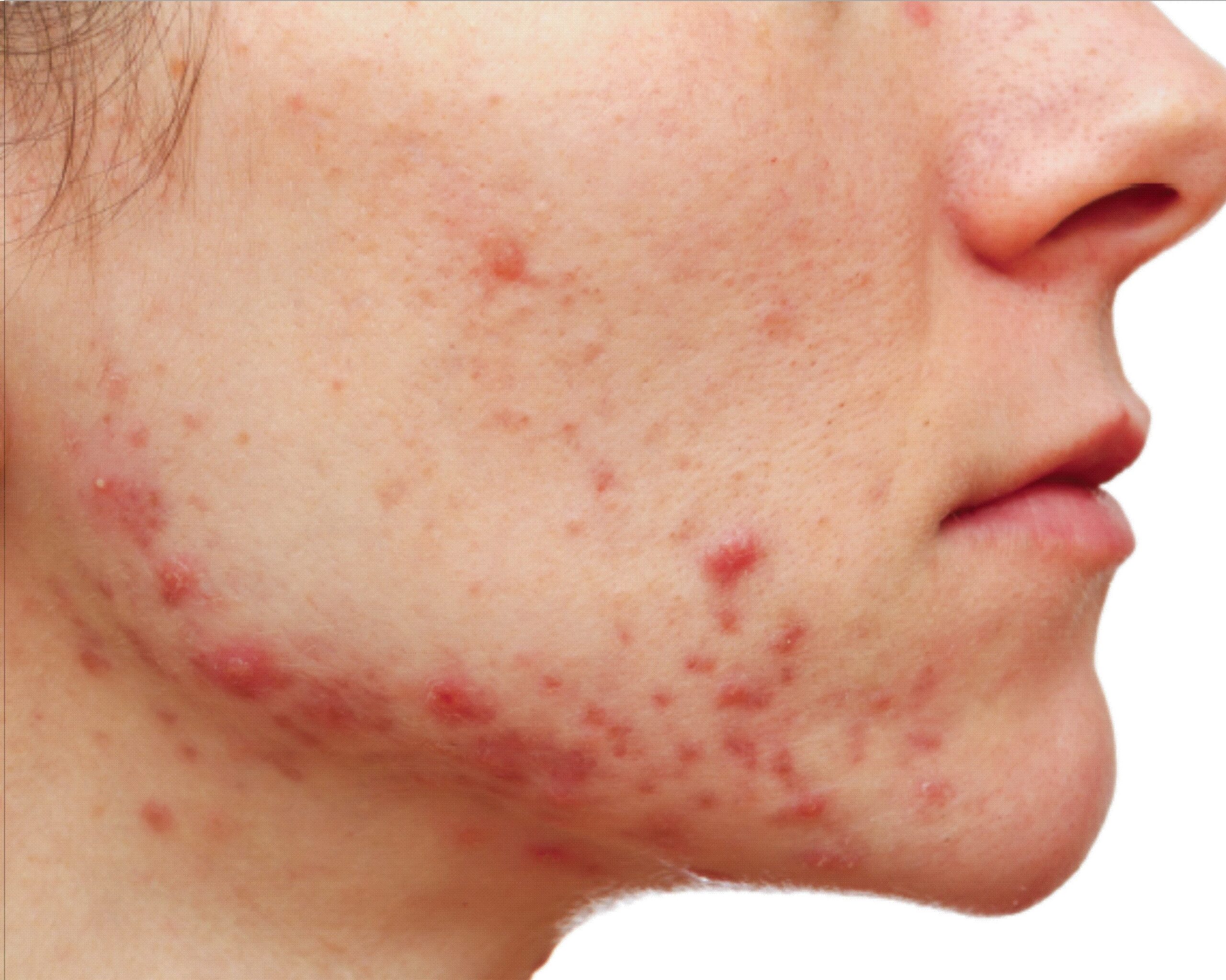 What Skin Routine Should You Follow for Acne?