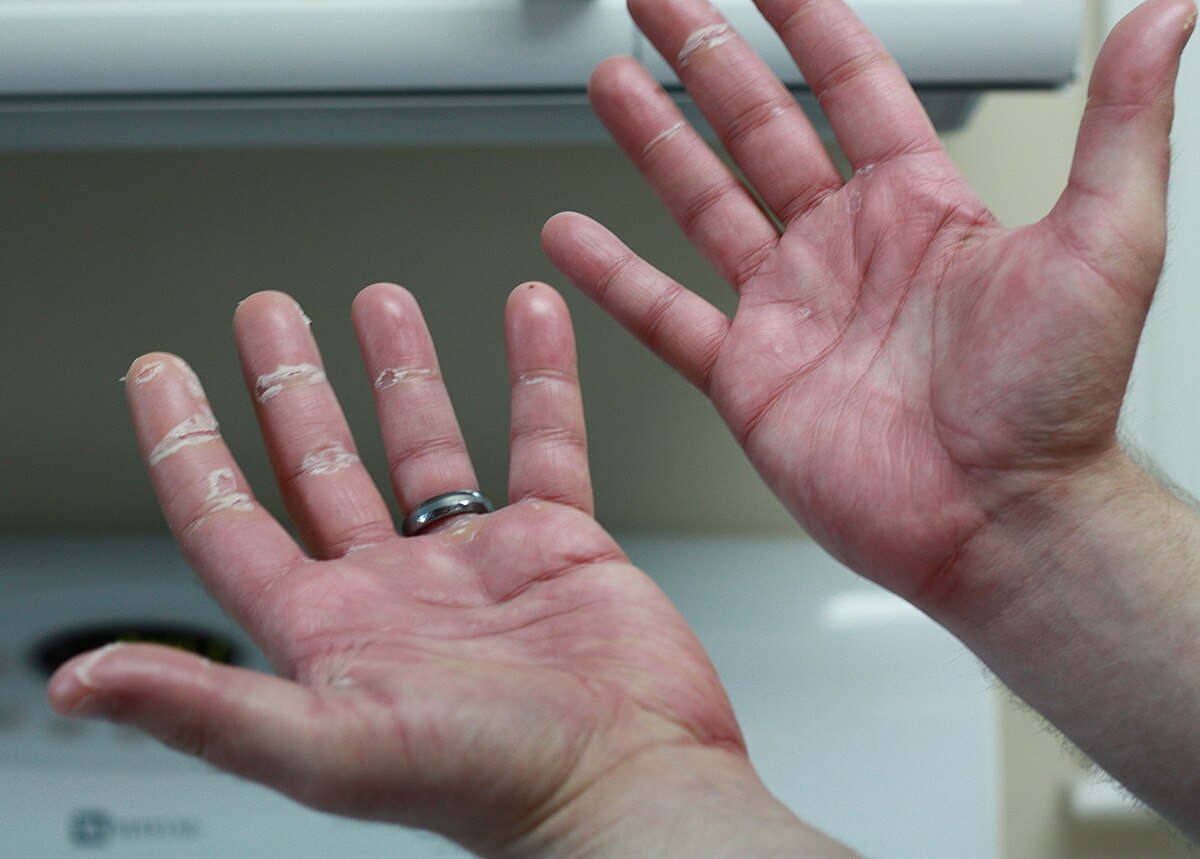 Hand Foot Syndrome Market to Surge with Nanotechnology-based Therapeutics