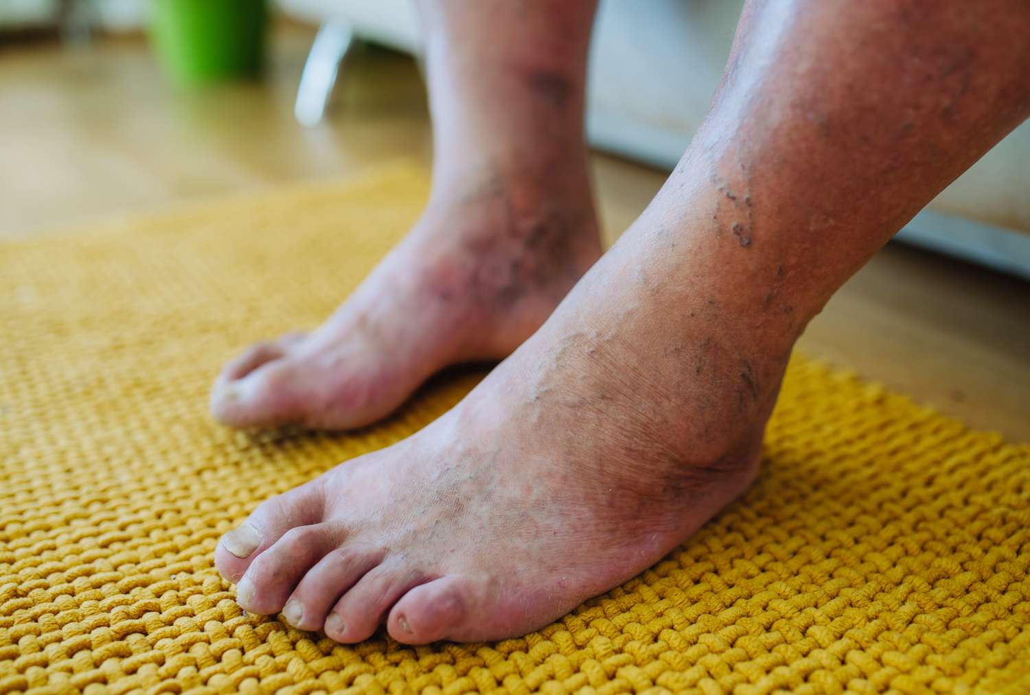 Diabetic Peripheral Neuropathy Market Set to Expand with Neuromodulation Therapies
