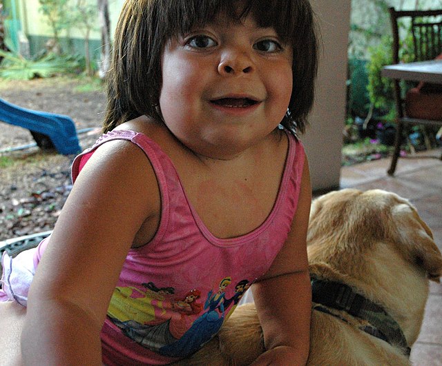 Sanfilippo Syndrome Market Witnesses Growth Due to Advanced Gene Therapy and Enzyme Replacement Solutions 