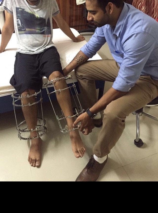 Understanding Limb Lengthening Surgery: A Comprehensive Overview