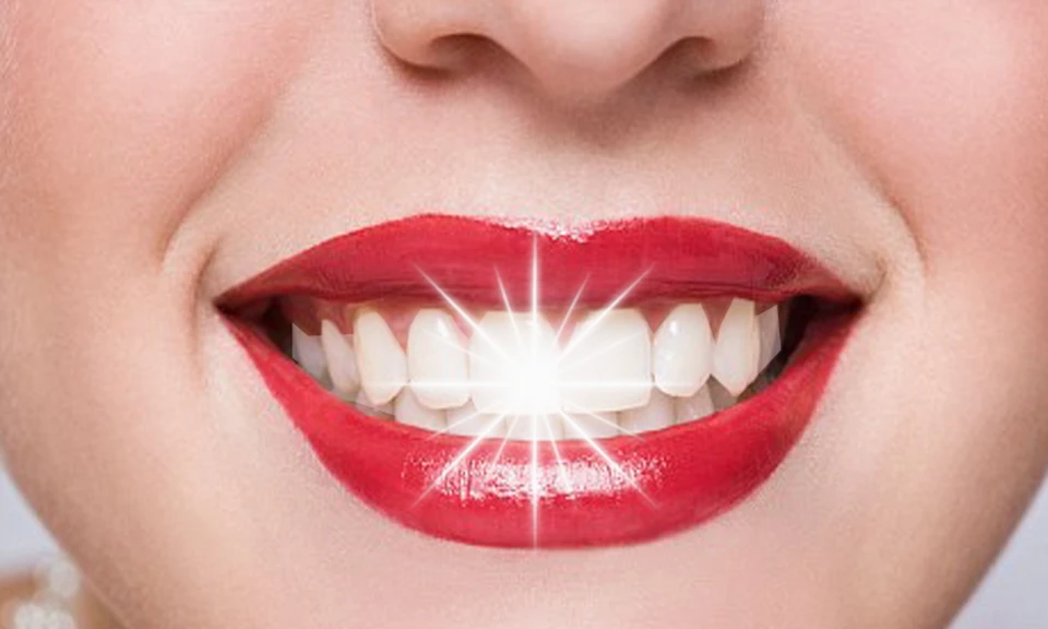 Brighten Your Smile With Teeth Whitening In Merrylands
