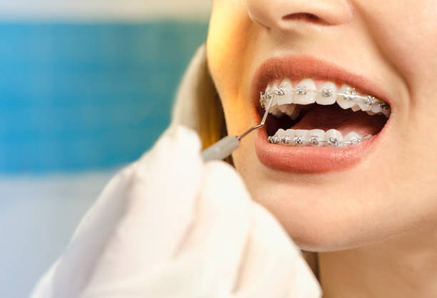 A Bright Smile Starts With Braces in Cupertino - What You Should Know