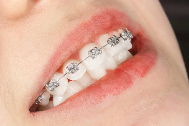 Unlocking Your Best Smile: A Complete Guide to Braces in Cupertino