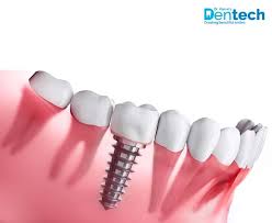 How to Choose the Right Clinic for a Dental Implant in Mumbai?