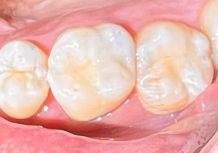 Tooth Colored Fillings Newport Beach – Need a Dentist?