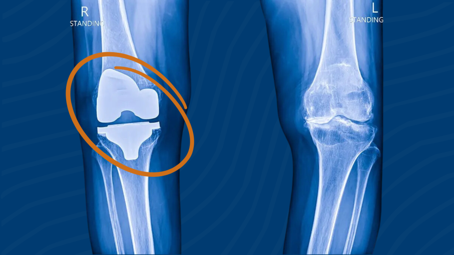 Why Knee Replacement Surgery Costs Are Skyrocketing: A Deep Dive into Healthcare Pricing