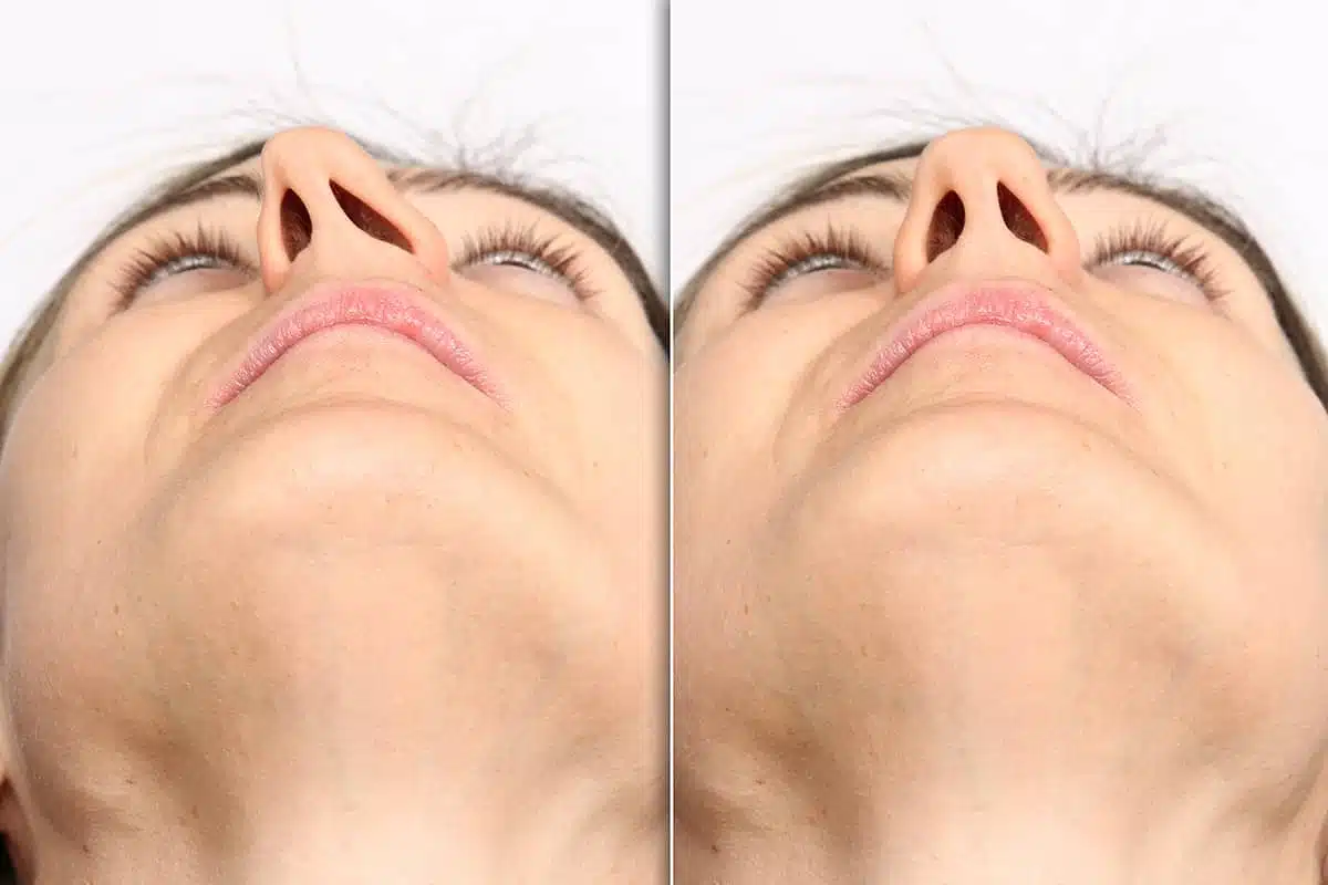Septoplasty Near Me: How to Choose the Right Surgeon for Cosmetic & Reconstructive Surgery