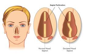 Septal Perforation Surgery Explained: Procedure, Recovery, and Results