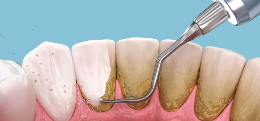 How To Safely Remove Tartar From Your Teeth