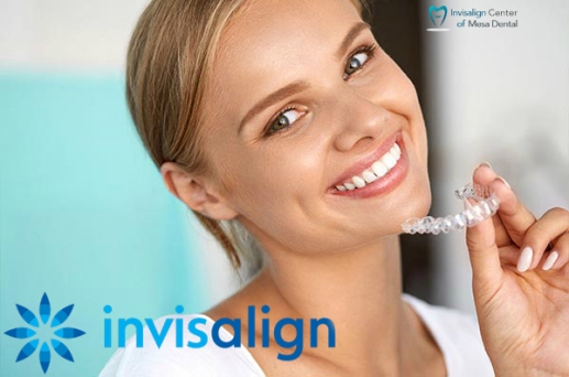 Invisalign Prices - How Much Does Invisalign San Diego Cost?