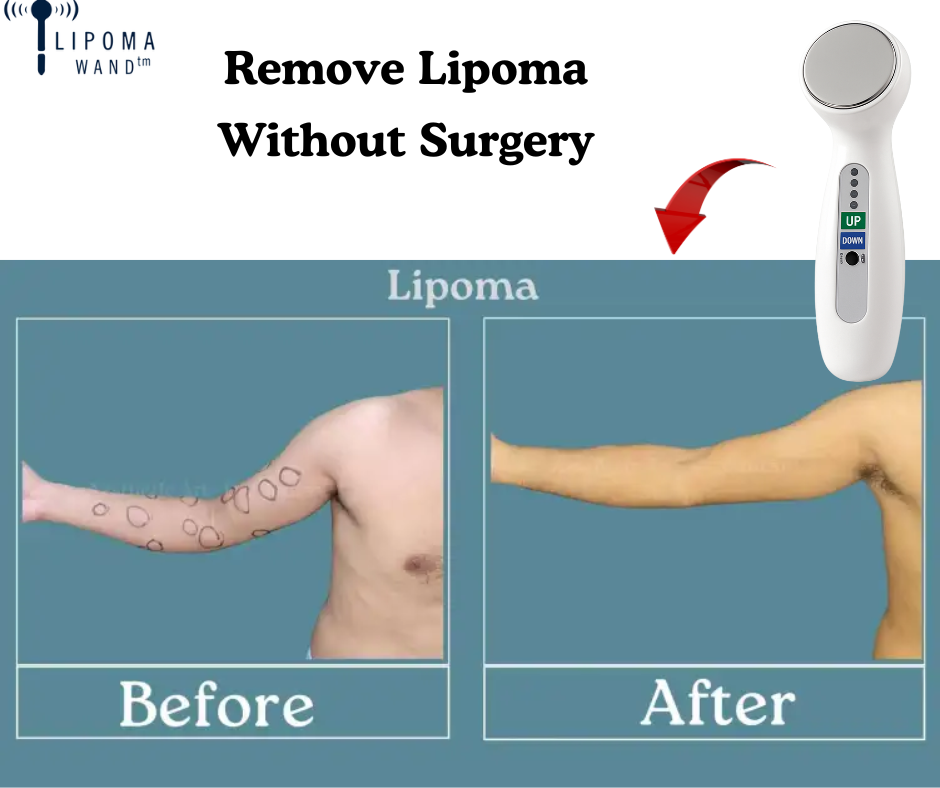 What is the Safest Way to Remove a Lipoma Without Surgery?