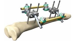 Global External Fixation Systems Market Report 2020 Forecast to 2025