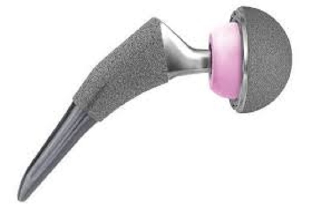 Global Hydroxyapatite-coated Femoral Components Market Report 2020 Forecast to 2025