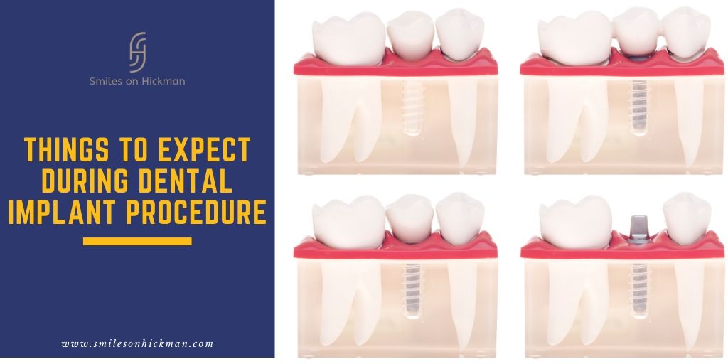 Things to Expect During Dental Implant Procedure