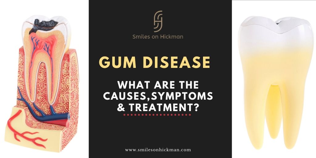 Gum Disease: Causes, Symptoms, and Treatment