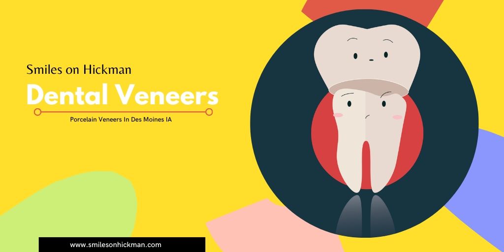 Porcelain Veneers In Des Moines IA