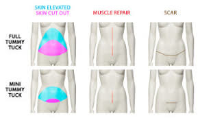 Mini-abdominoplasty: Tummy tuck alternatives