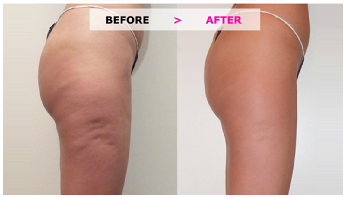 Get Cellulite & Fat Reduction Treatment in Delhi