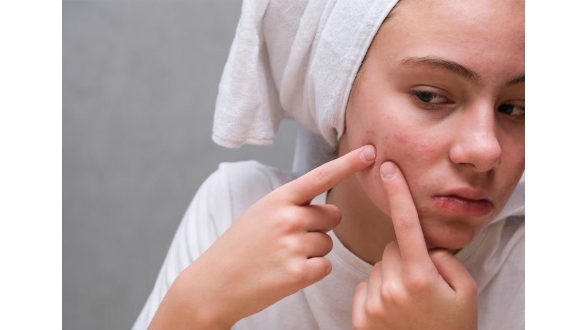 Can Diet and Lifestyle Changes Be Considered Natural Acne Treatments?