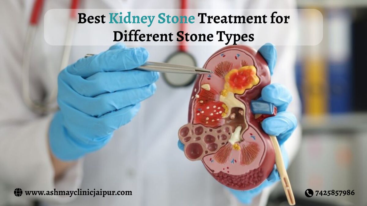 Best Kidney Stone Treatment for Different Stone Types