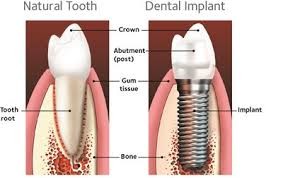 The 12 answers to your questions about dental implants