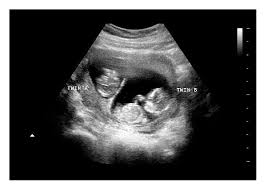 How to Spot a Fake Ultrasound