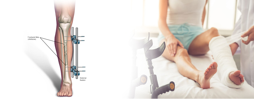 A Comprehensive Guide to Fracture Treatment in Khar West