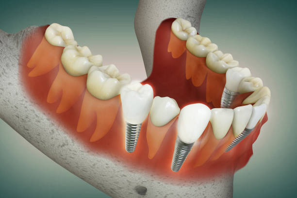 Is Choosing Cheap Dental Implants in NYC a Smart Move?