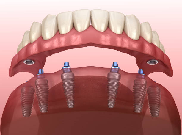 Is Choosing the Right Full Arch Implant Surgeon Worth It?