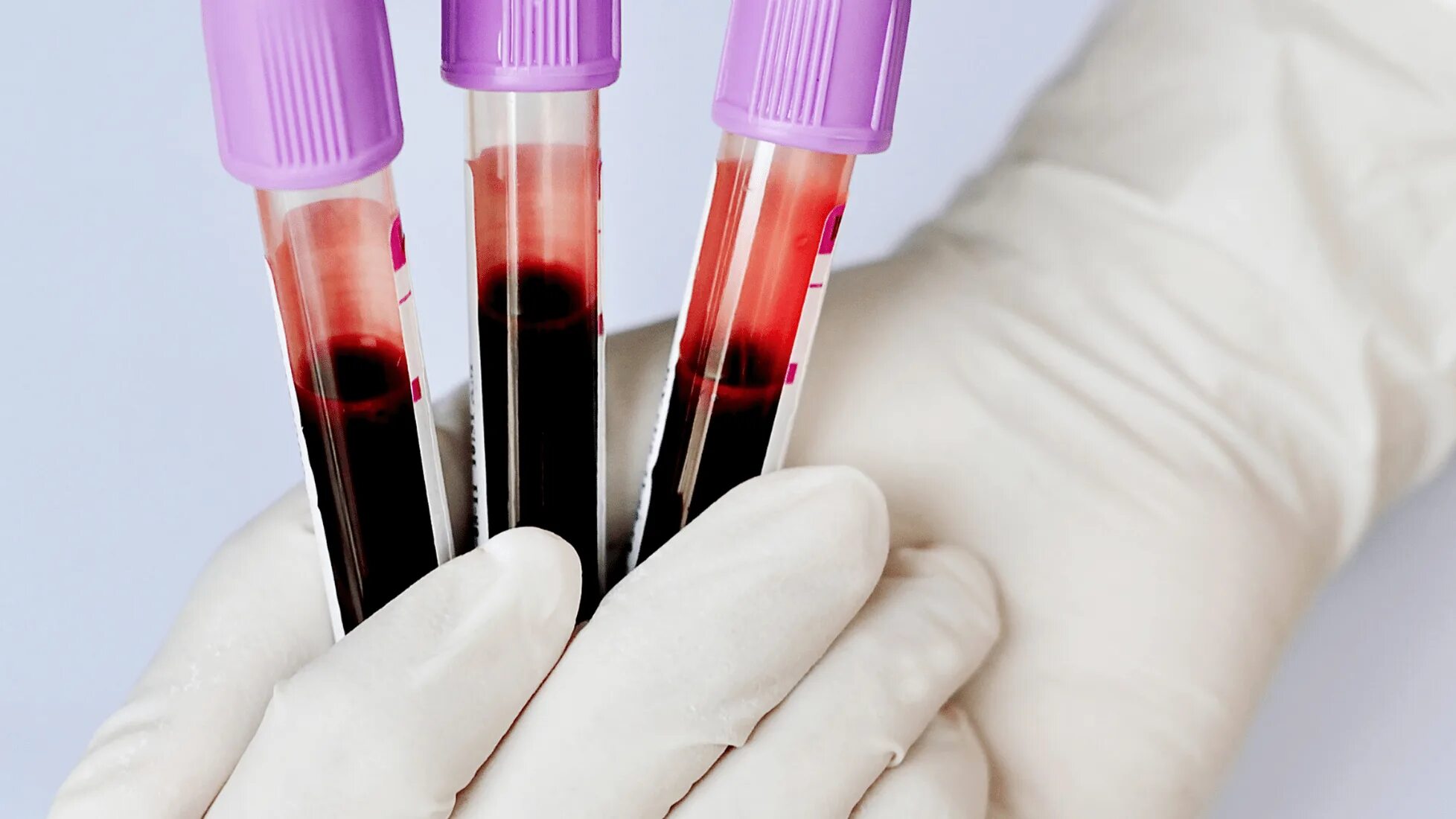 At-Home Candida Test: Is It Reliable?