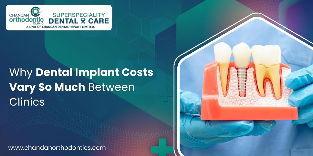 Why Dental Implant Costs Vary So Much Between Clinics