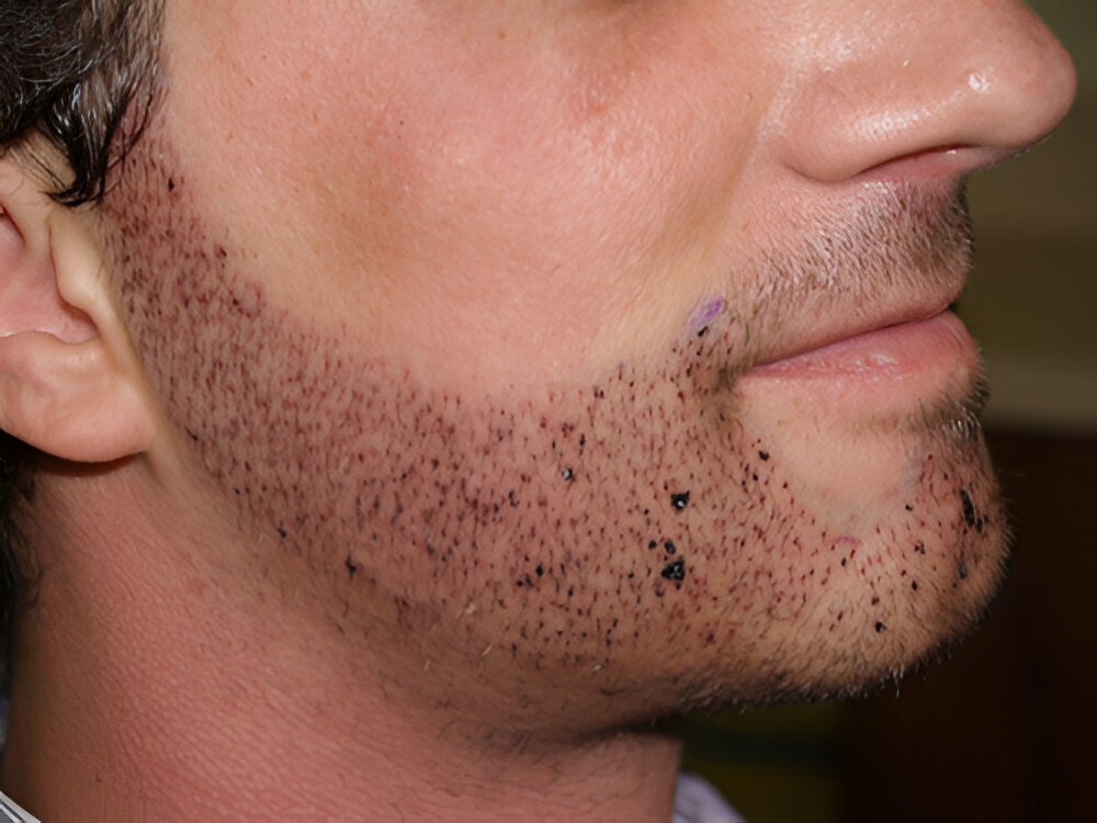 How Beard Transplant Restores Confidence Naturally