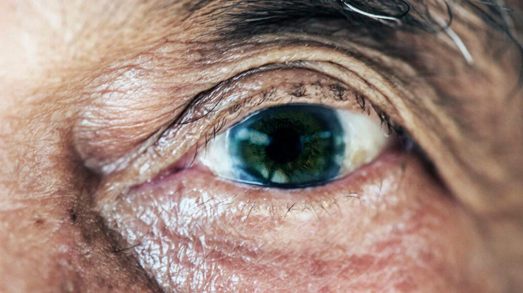 Can A Stem Cell Therapy Give Hope to Patients with Eye Disease?