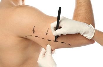 Arm Surgery for Sagging Skin: How Brachioplasty Can Help