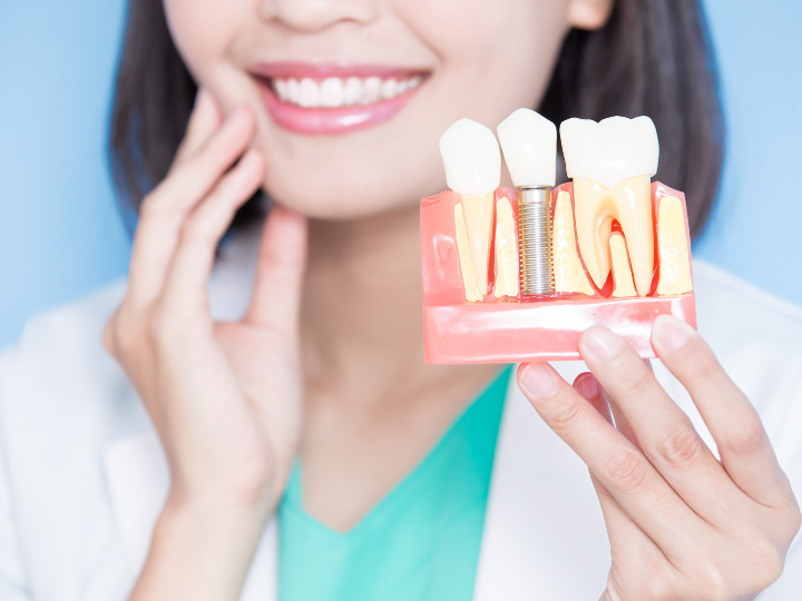 Top Benefits of Dental Implants You Probably Didn’t Know About
