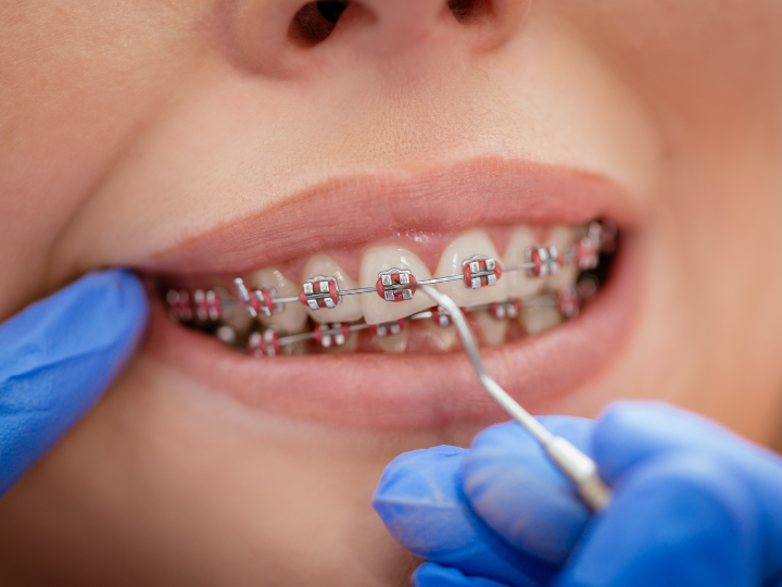How Orthodontists Calculate the Cost of Braces