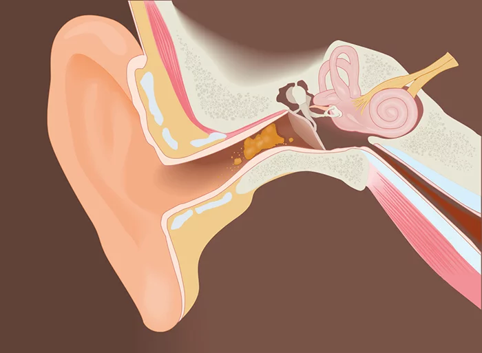 Ear Wax Removal: A Complete Guide to Healthy Ears
