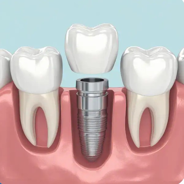 Root Canal Treatment Penrith