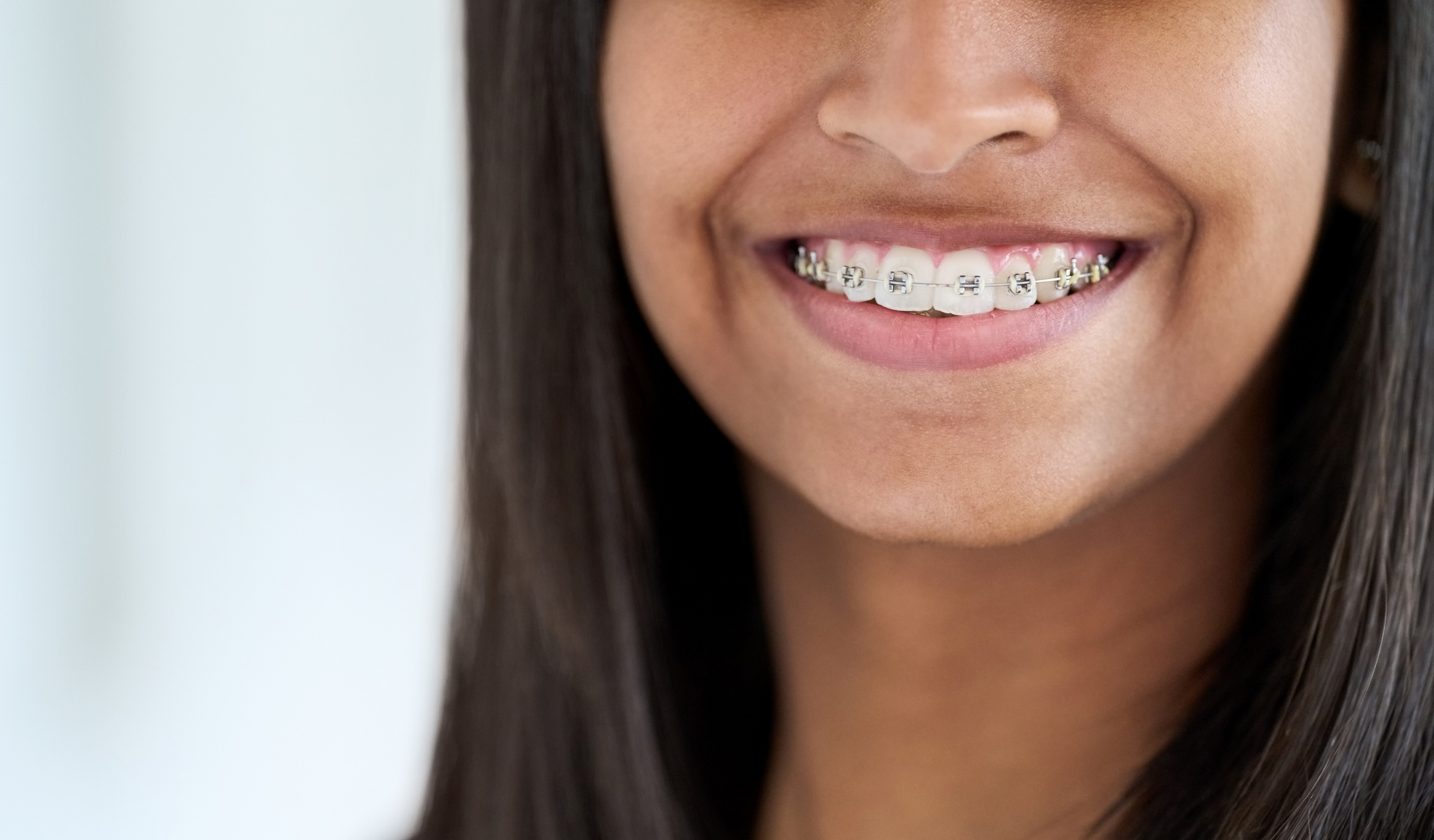 Which Age is Best for Teeth Braces?