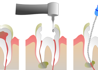 ROOT CANAL TREATMENT