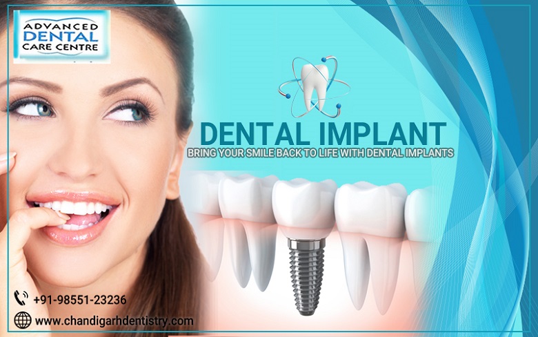 Dental Implant Surgery in Chandigarh