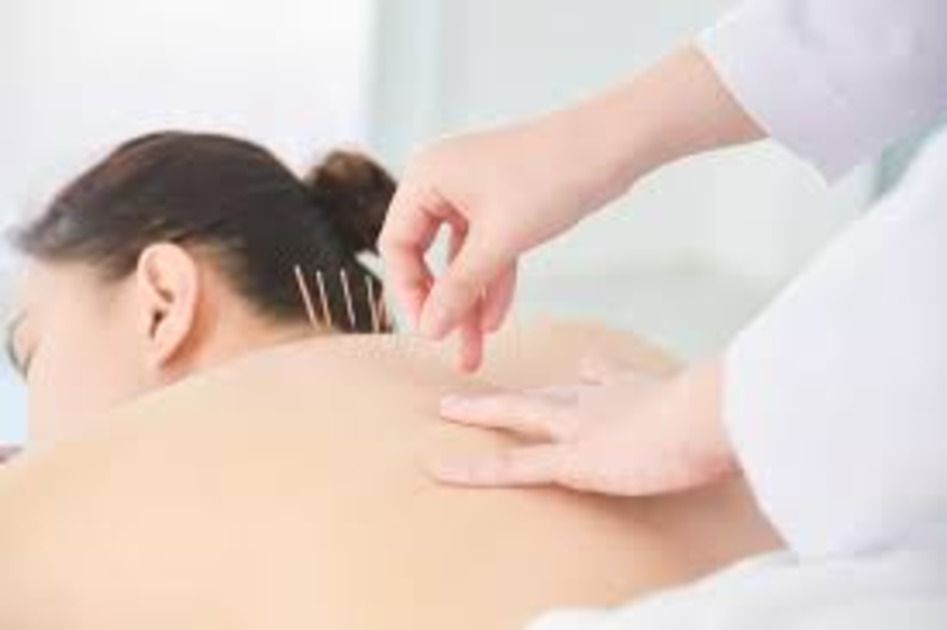 Morristown Acupuncture for Headache: A Natural Solution