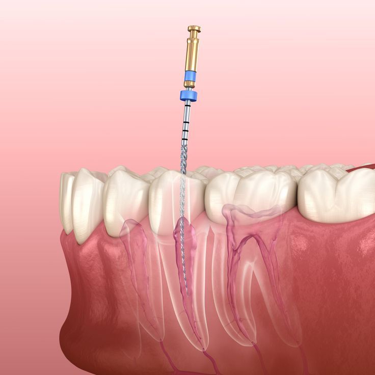 Get Relief from Tooth Pain with Expert Root Canal Treatment in Gokula